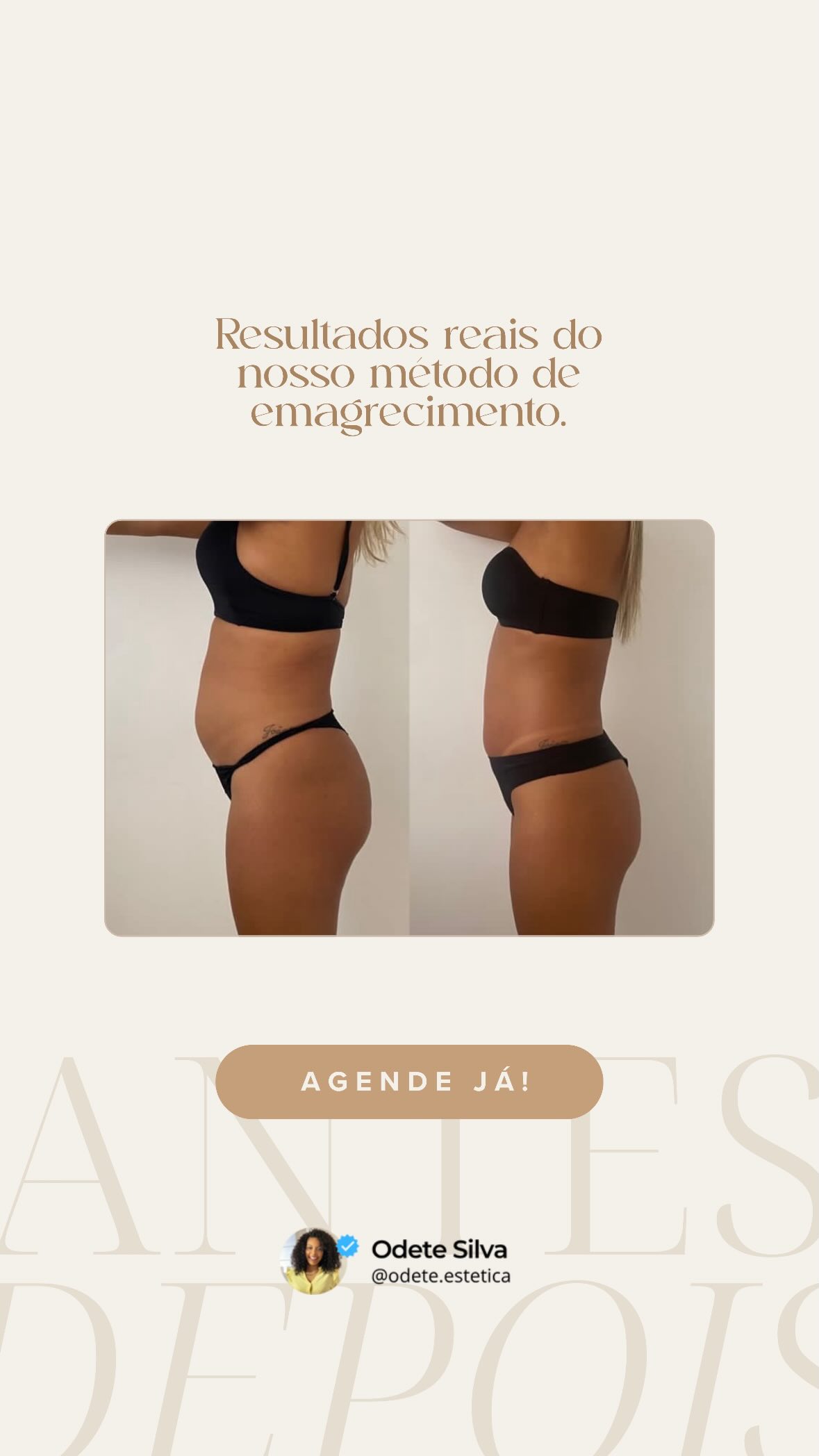 Antes e depois de paciente do Método Odete de emagrecimento, vista lateral do abdômen