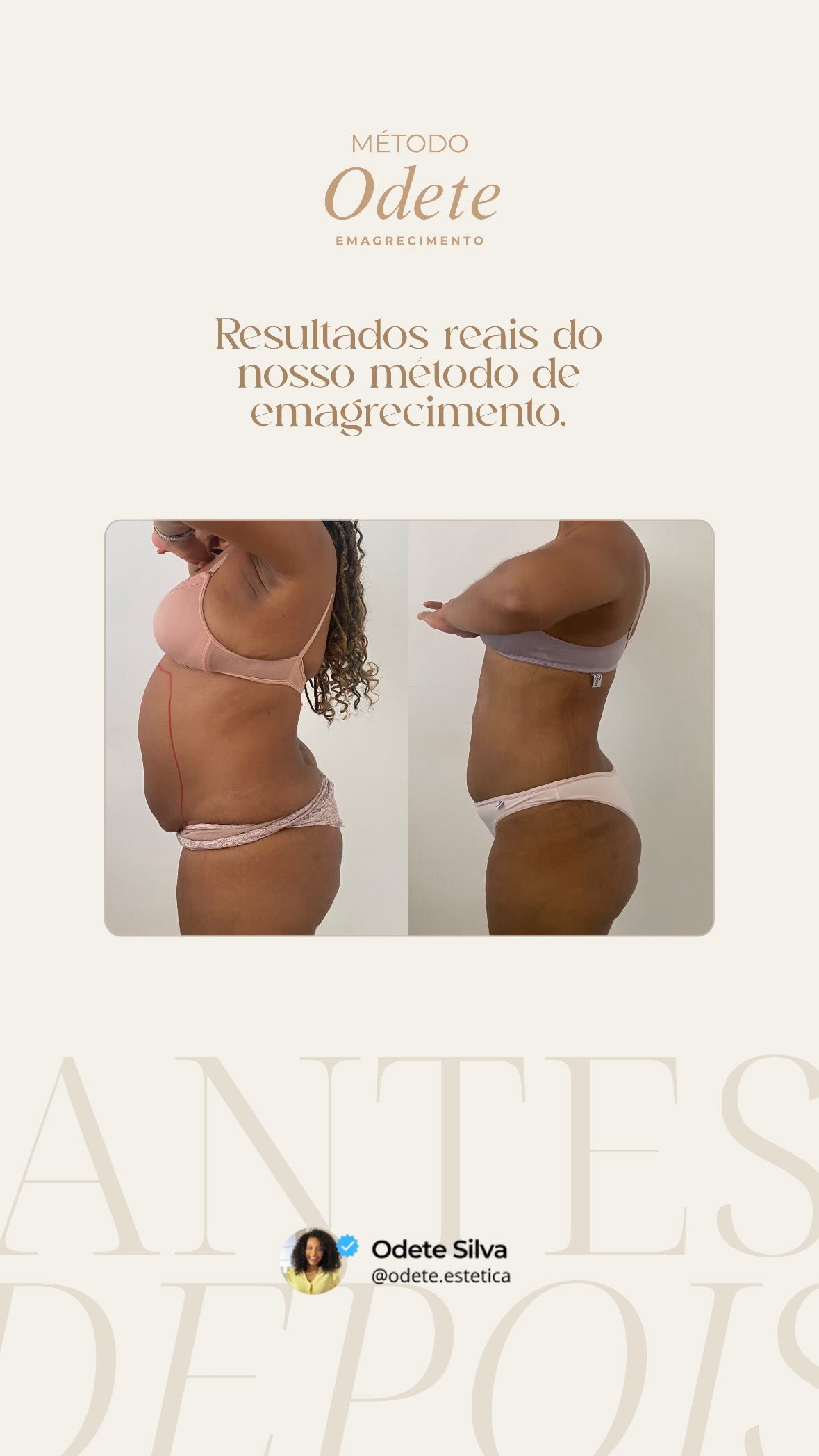 Antes e depois de paciente do Método Odete de emagrecimento, vista lateral do abdômen