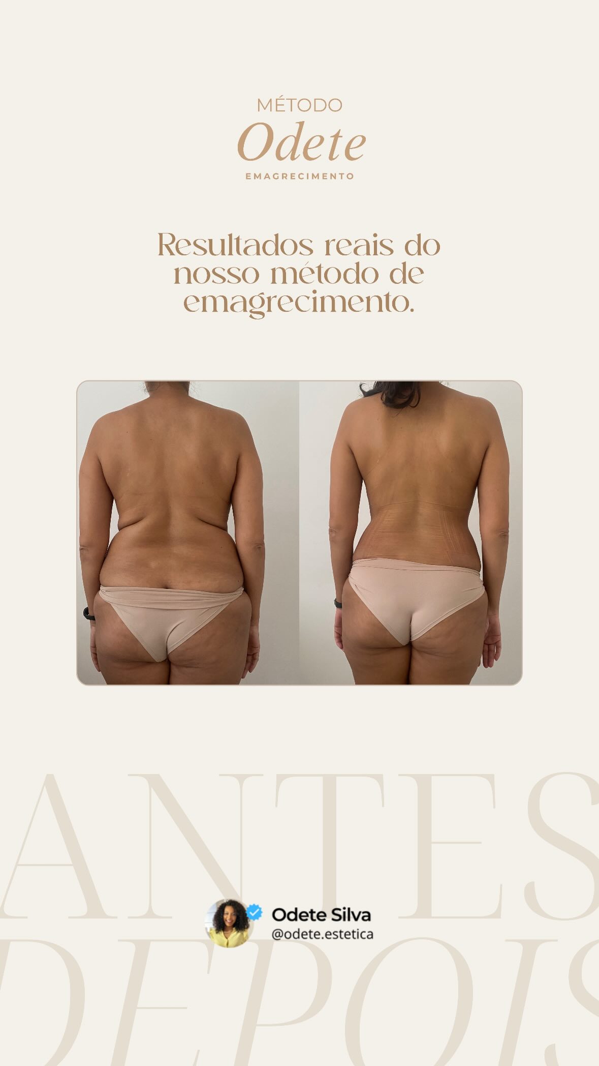Antes e depois de paciente do Método Odete de emagrecimento, vista das costas