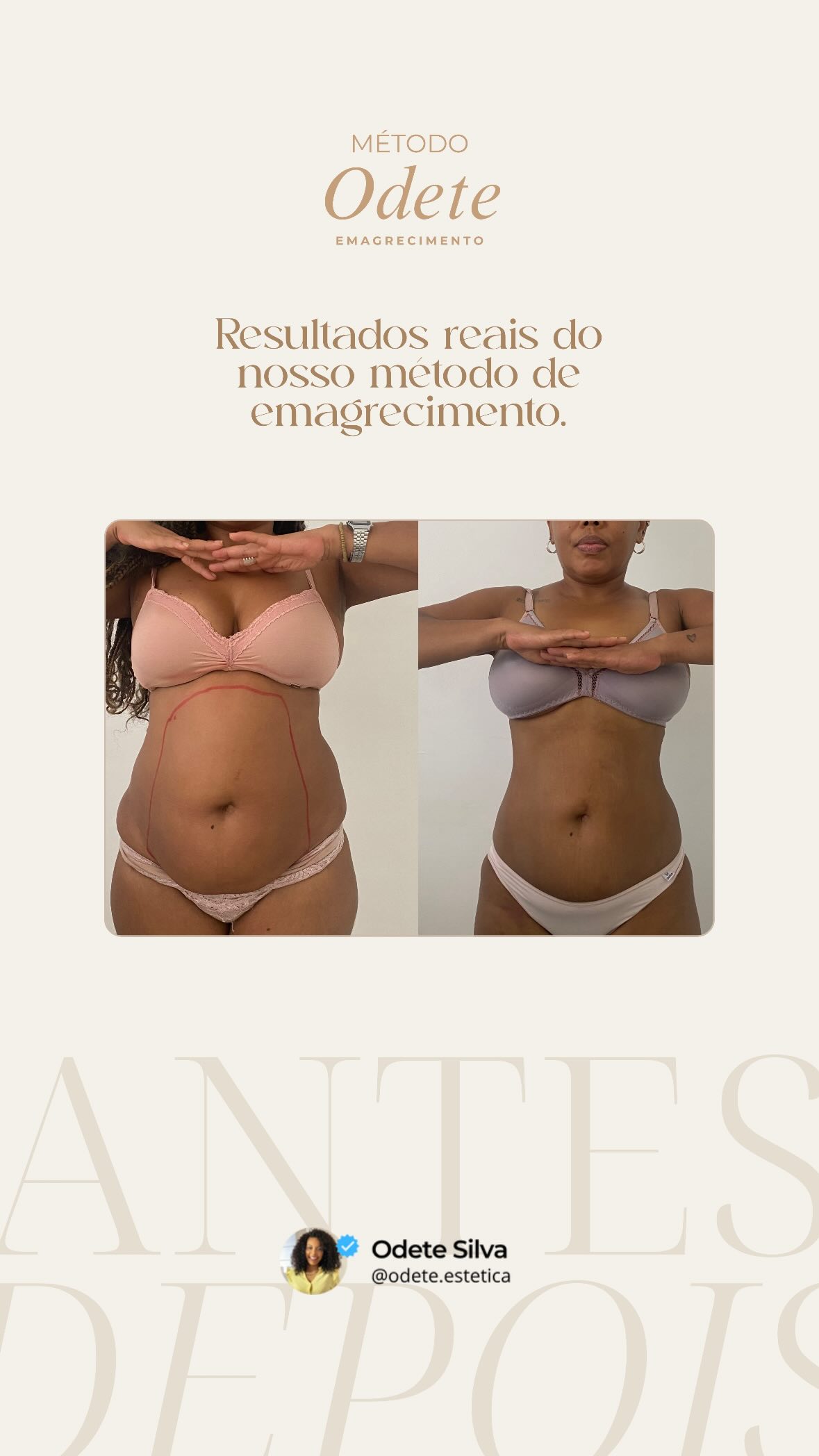 Antes e depois de paciente do Método Odete de emagrecimento, vista frontal do abdômen