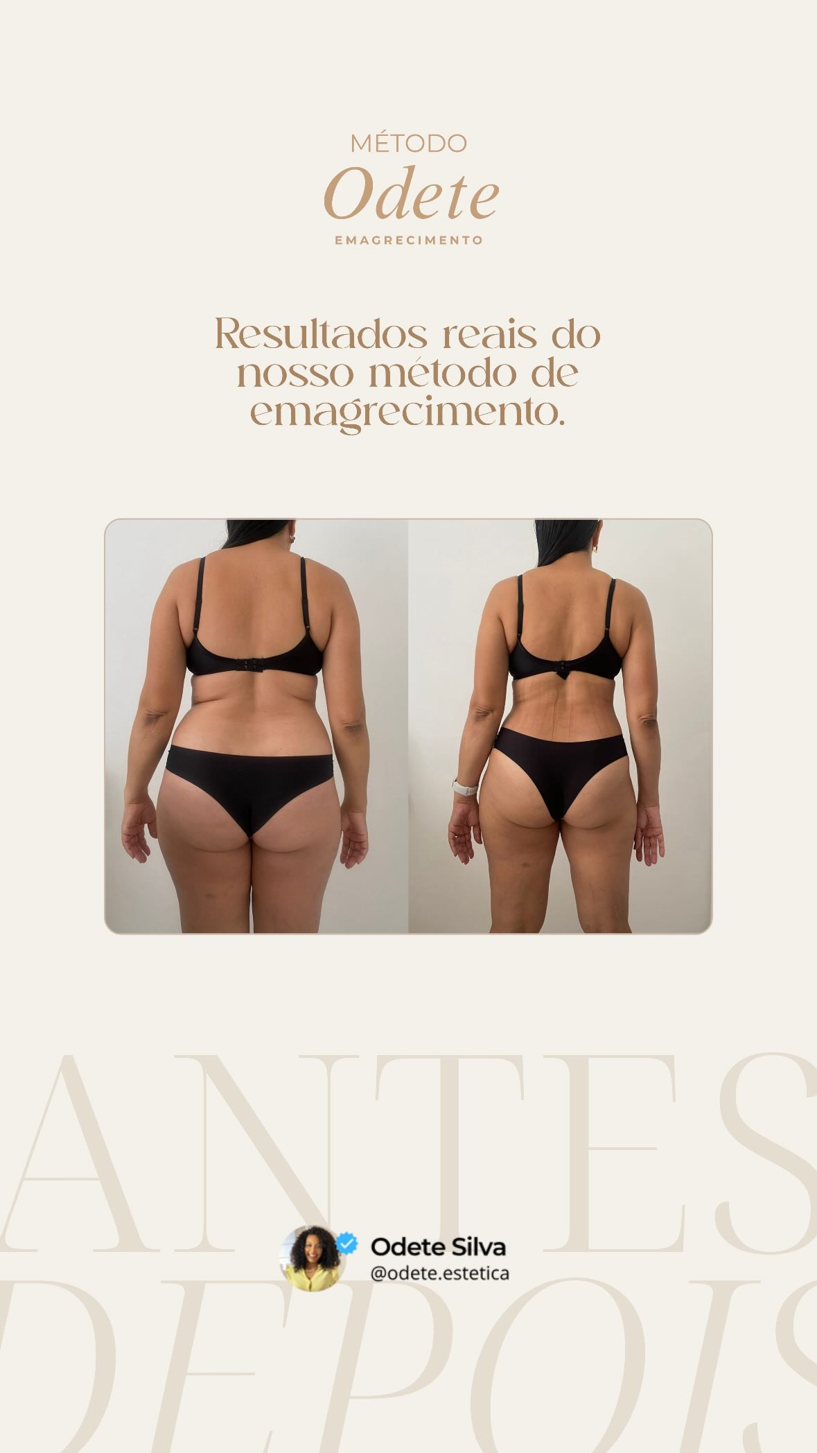Antes e depois de paciente do Método Odete de emagrecimento